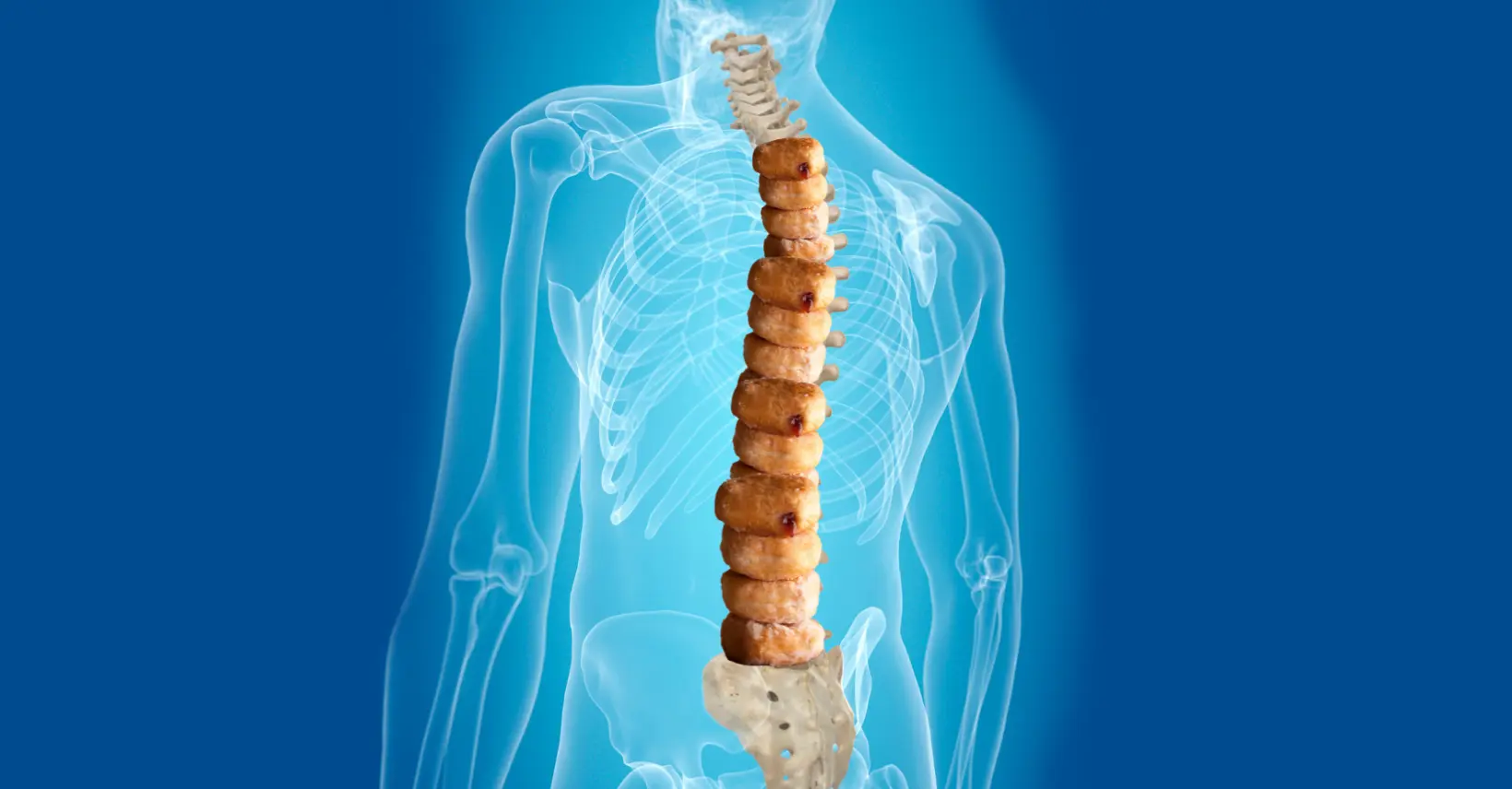 Jelly donut analogy illustrating spinal disc degeneration