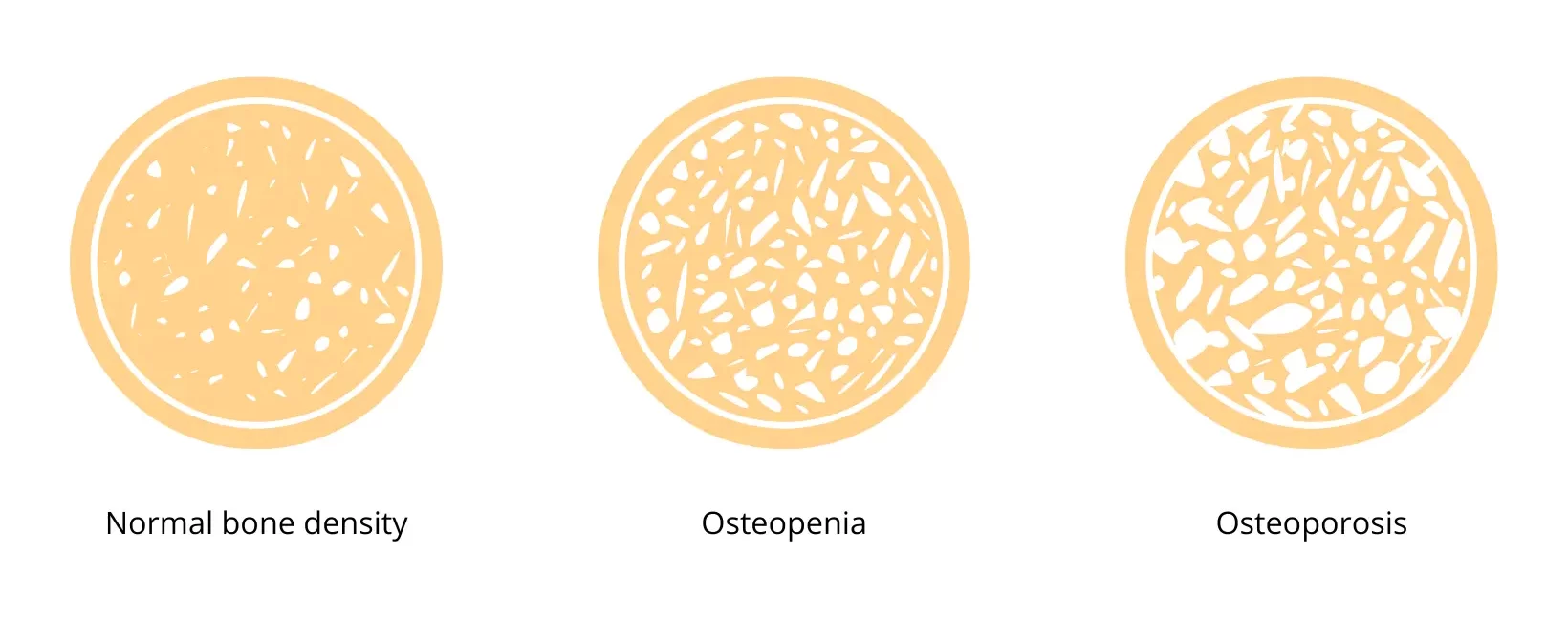 Bone density from normal, osteopenia and osteoporosis