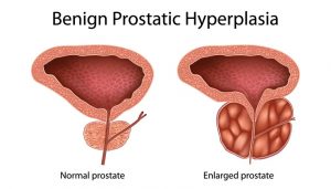 beign-prostatic-hyperplasia