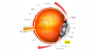 beacon-cataract-lens