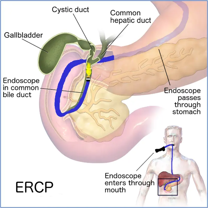 endoscopic-retrograde-cholangiopancreatography-beacon-malaysia