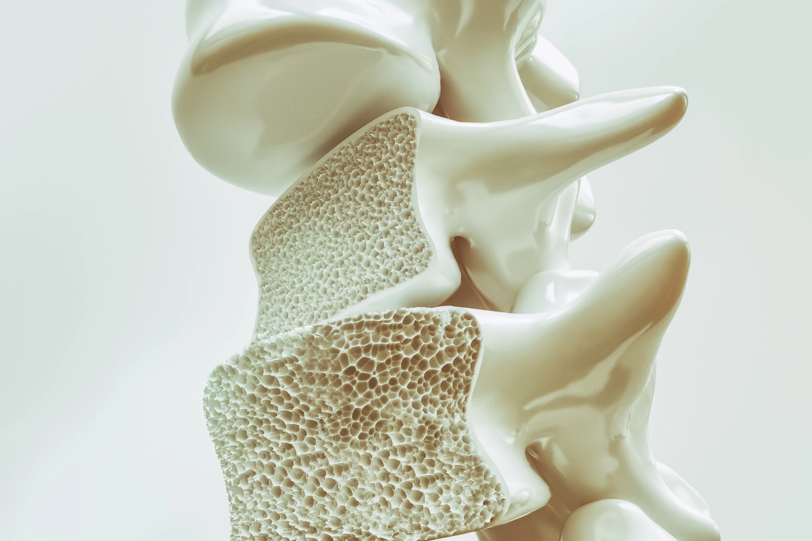 Cegah Osteoporosis, Patah Tulang Yang Bisa