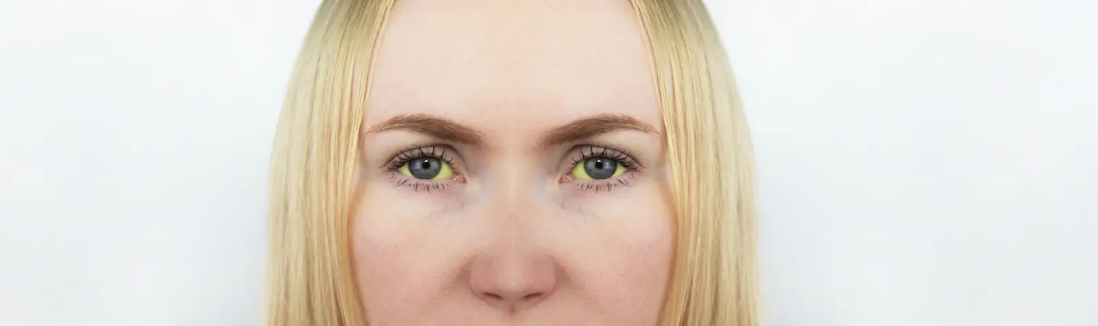 Getting to know jaundice : the reason behind yellow eyes, dark urine & more
