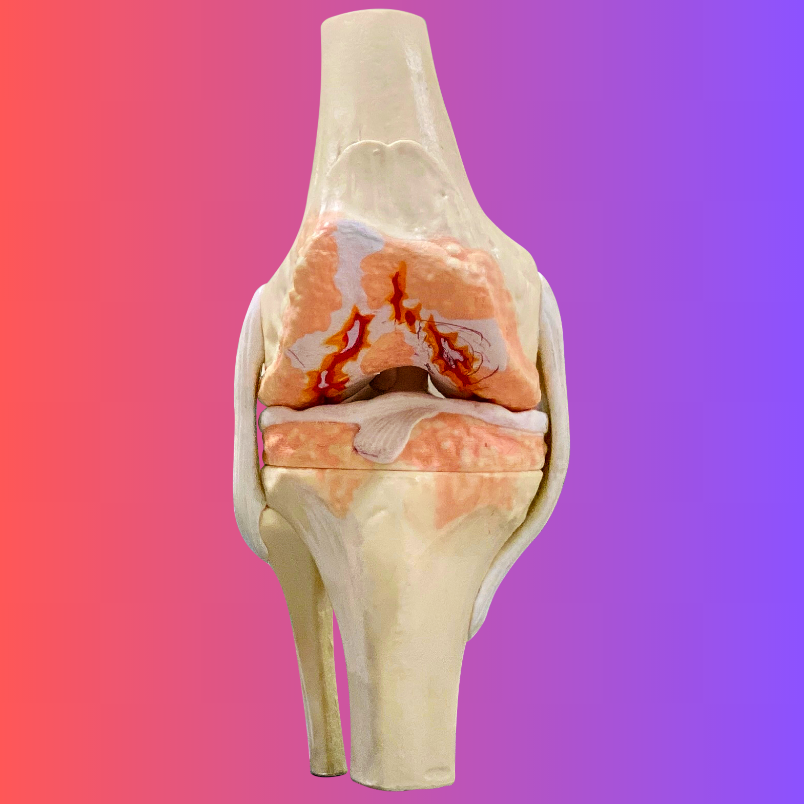 Knee-Before-Total-Knee-Replacement-Surgery